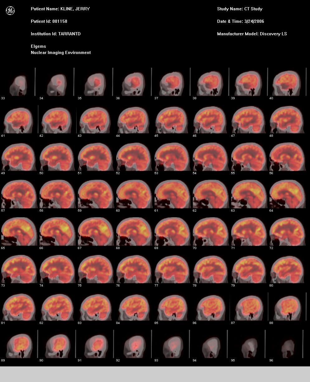 Sagittal Fused Images